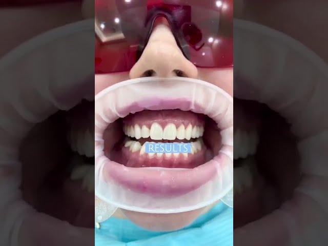 Before & After- Laser teeth whitening in 60 secs