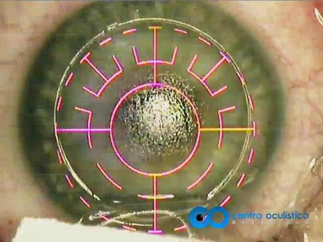 Femto-LASIK Procedure