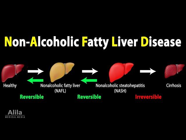 Nonalcoholic Fatty Liver Disease (NAFLD), Animation