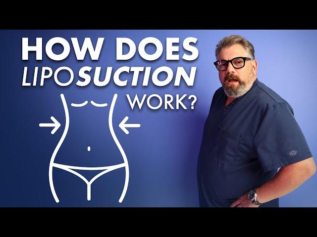 The Real Deal On How FAT Is Removed In Liposuction