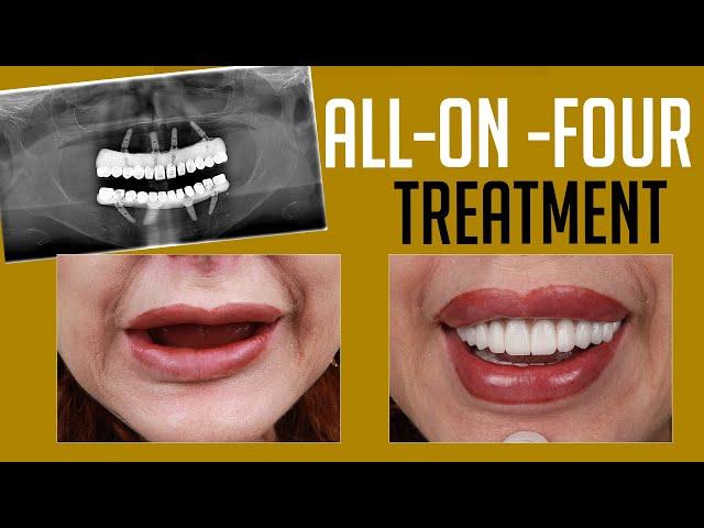 All-on-4 Dental Implants: Watch This Before You Decide!