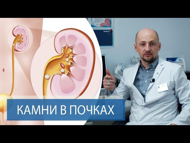 КАМНИ В ПОЧКАХ - Симптомы и лечение | Мочекаменная болезнь