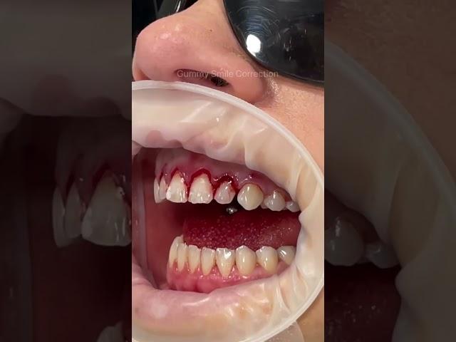 This technique is known as a gum lift, gum contouring or gum augmentation 