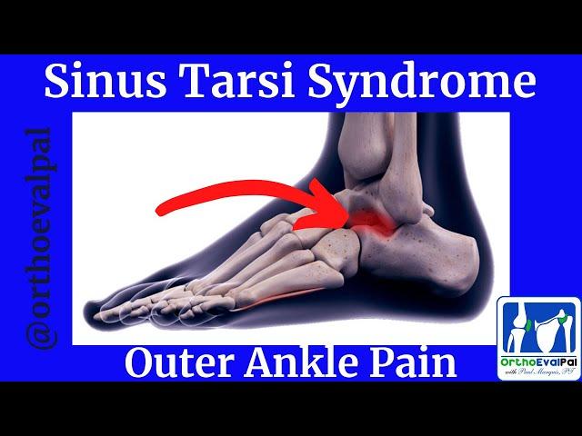 Sinus Tarsi Syndrome (Outer Ankle Pain)