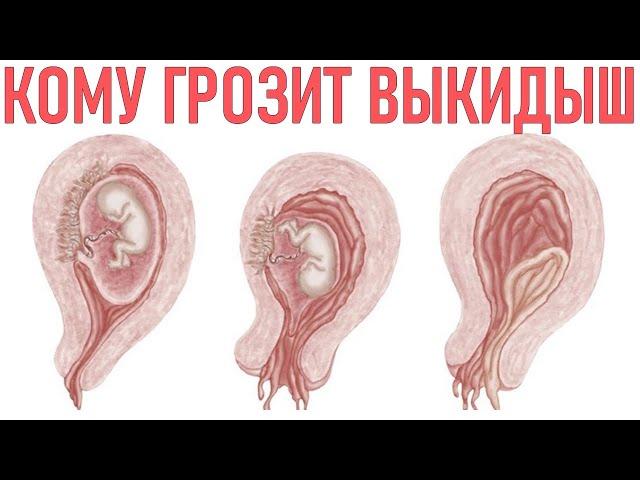 УГРОЗА ВЫКИДЫША | Почему происходит выкидыш