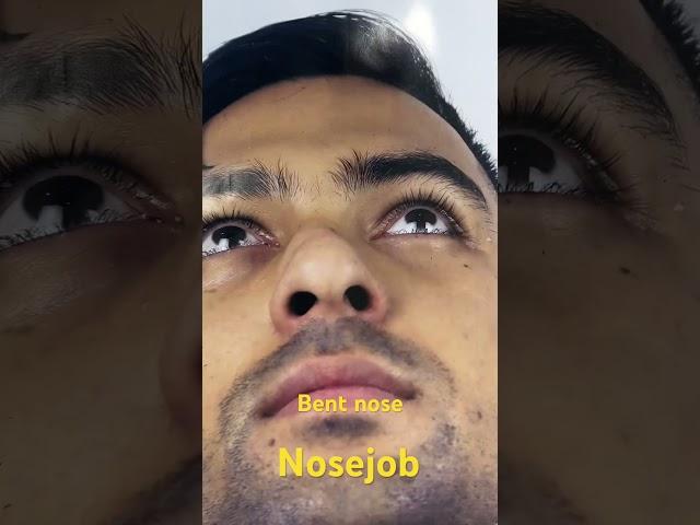 Best Crooked Bent Nose Correction plastic surgery