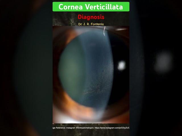 Cornea Verticillata. Diagnosis’.