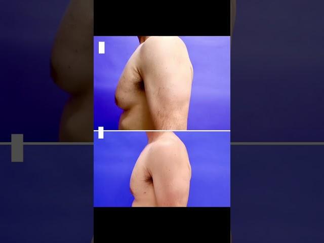 Gynecomastia Before And After | Avance Plastic Surgery Institute: Dr. Erez Dayan | Reno, NV