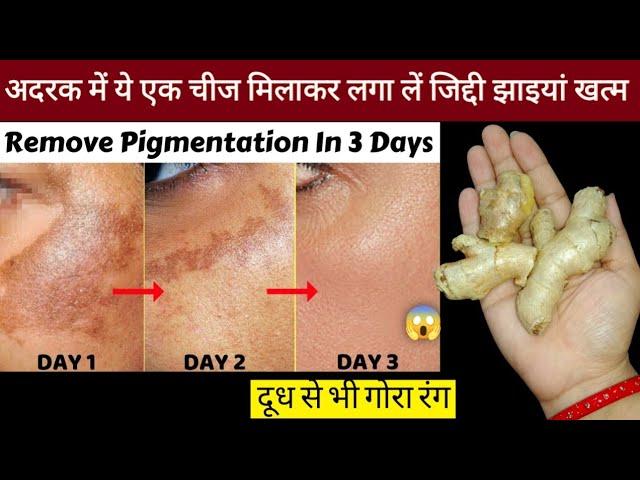 अदरक से झाइयां हटाने का कमाल का तरीका | Reduce Melasma, Pigmentation, Discolouration, Blackspots