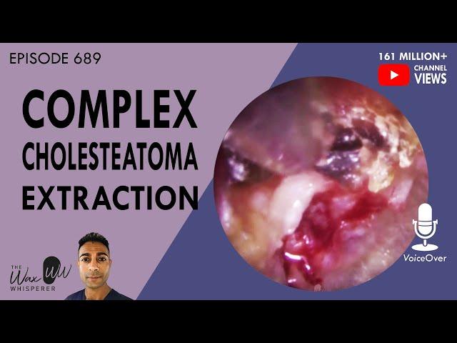 689 - Complex Cholesteatoma Extraction