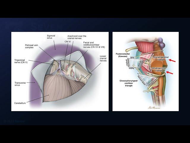 Extended Retrosigmoid Craniotomy for Resection of a Petrotentorial Meningioma