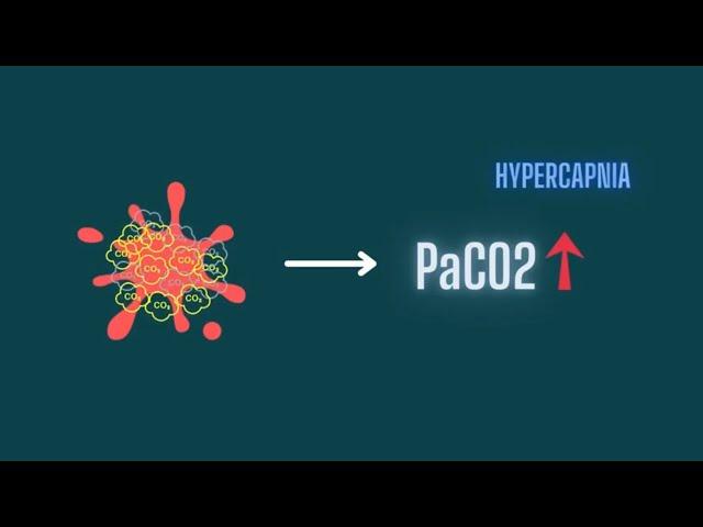 Hypercapnia: Pathophysiology Of CO2 Retention