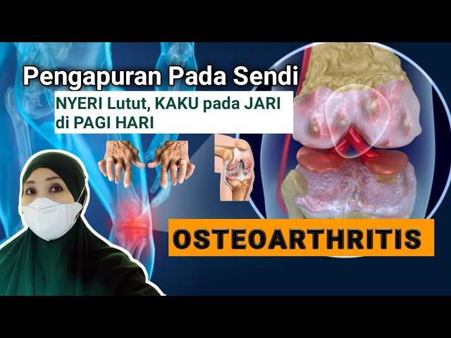 SENDI BENGKAK dan KAKU saat BANGUN TIDUR -mungkin kamu mengalami OSTEOARTHRITIS