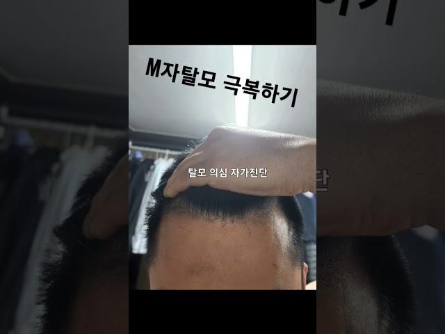 초기 M자탈모 극복