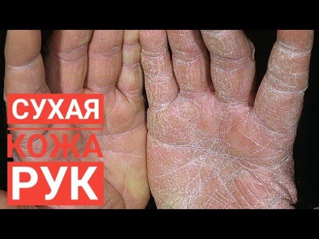 Сухая кожа рук. Копеечное аптечное средство- антисептик и для смягчения кожи рук!