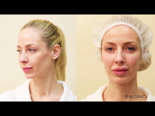 REAL CLINIC | Увеличение губ и скул | Контурная пластика JUVEDERM