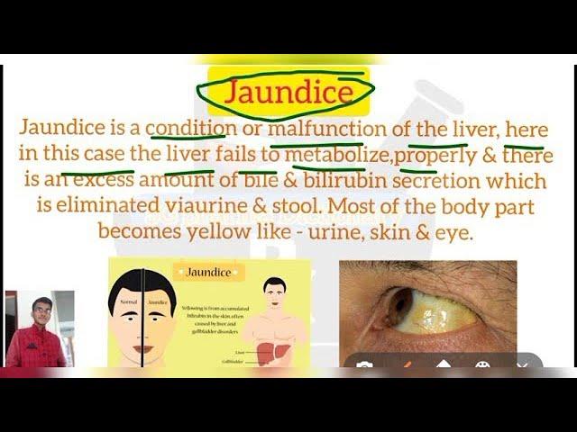 Jaundice ll Definition in Hindi ll Causes and Symptoms ll @SG Pharma Dictionary1M