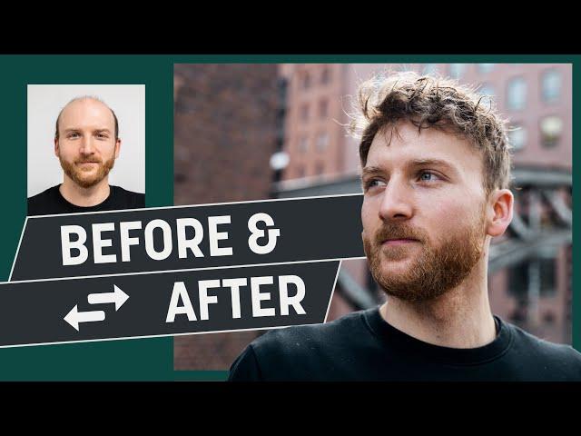 Enough with baldness – I want a hairstyle! | Hair replacement before & after | Heydecke Hairsystems