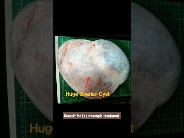 Large Ovarian Cyst #shorts #healthmedia