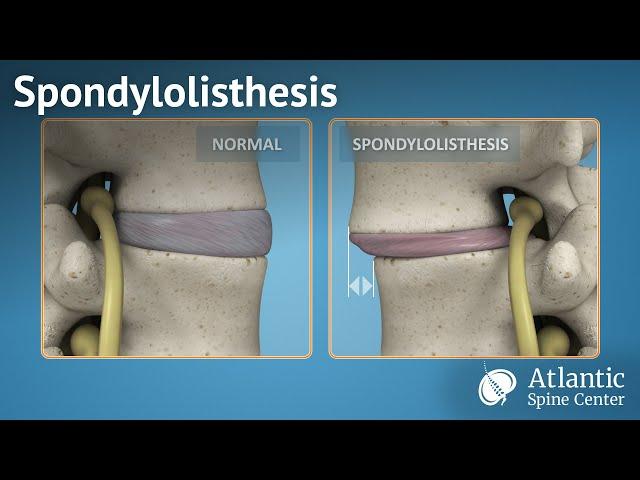 Spondylolisthesis