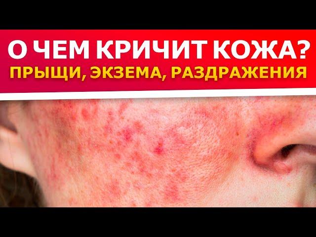 90 % проблем с кожей из-за ПСИХОСОМАТИКИ || Как вылечить кожные заболевания?