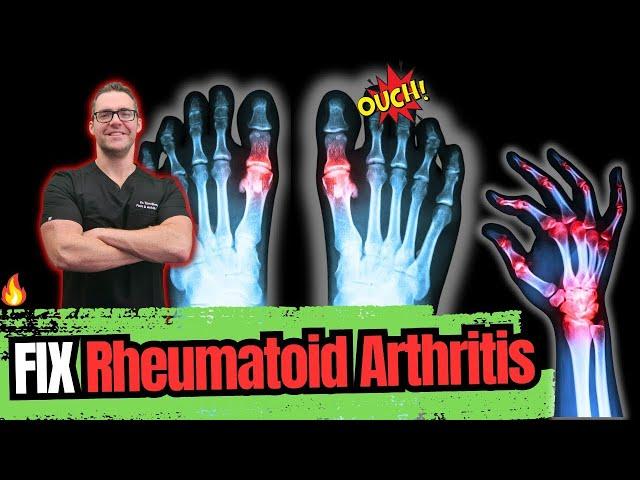 Rheumatoid Arthritis [Symptoms, Early Signs, Stages & BEST Treatment]