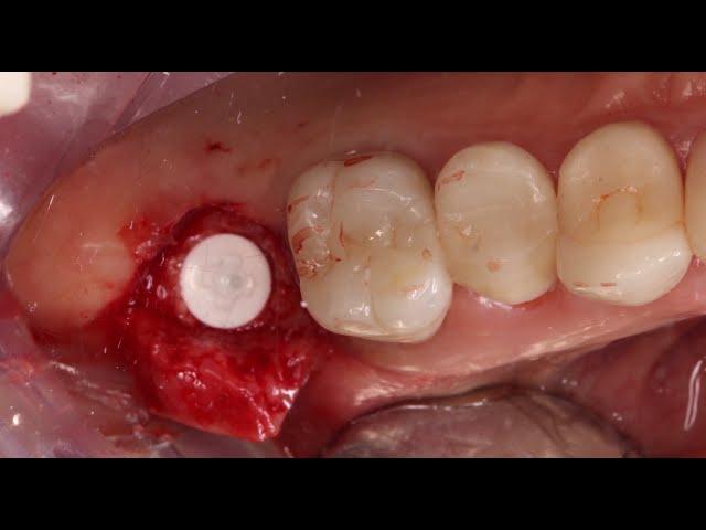 Crestal Sinus Lift with PRF and Simultaneous Zeramex XT Implant Placement