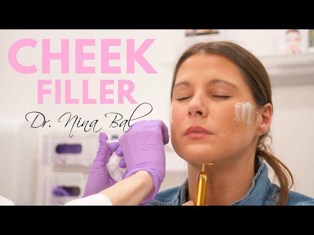 Cheek Filler Before and After | Dr. Nina Bal | London  Cheek Filler Treatment