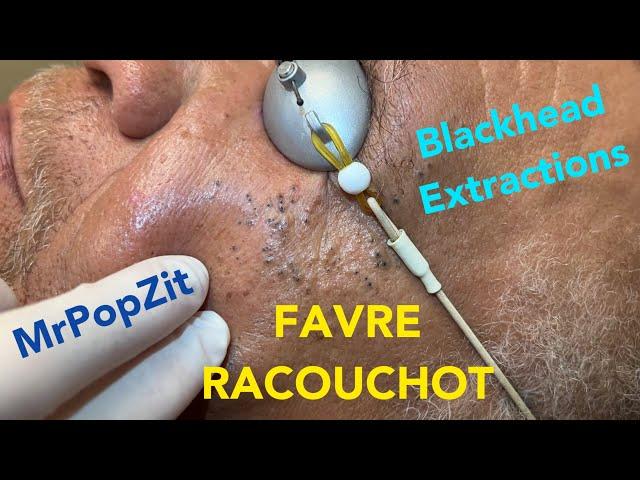 Favre Racouchot syndrome.Dozens of comedones extracted.Whiteheads and blackheads. Clearing the pores