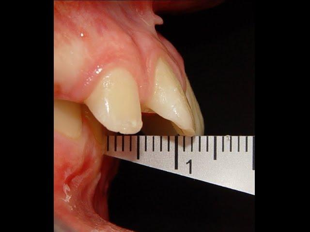 Modern concept to treat severe class II in children using 2x4 Appliance