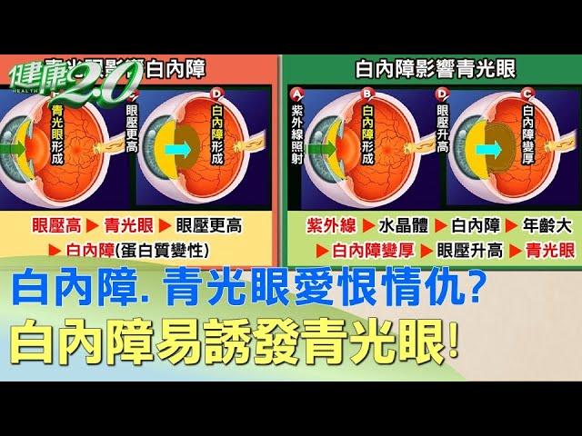 白內障vs.青光眼愛恨情仇？白內障易誘發青光眼！ 健康2.0