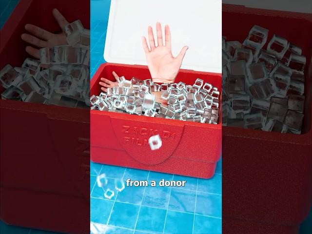 How A Hand Transplant Works  Surgeon Reacts