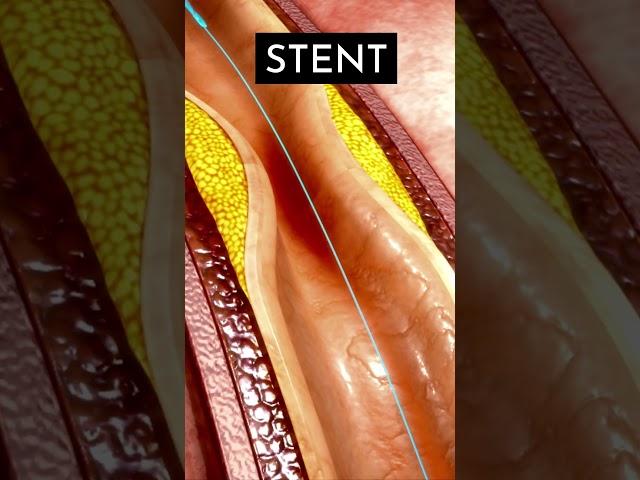 हार्ट के ब्लॉकेज कम करने का आसान उपाय Heart Blockage Explained in 3D Animation