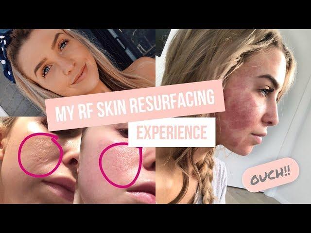 My RF Skin Resurfacing Experience