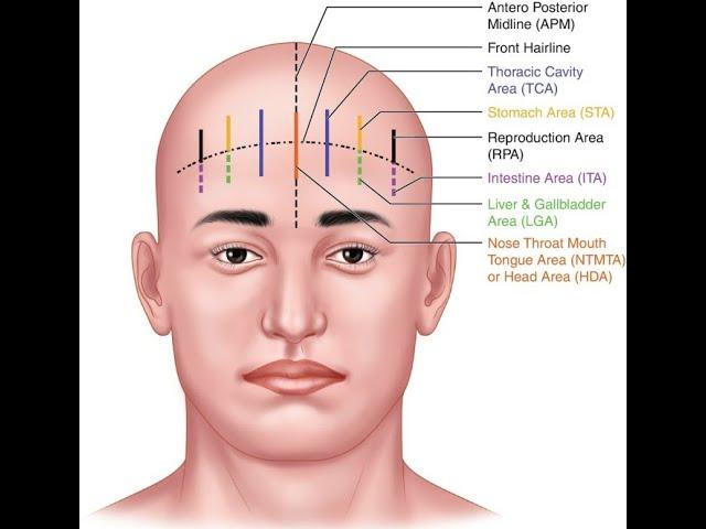 SCALP ACUPUNCTURE: Principles of Point Selection, Indications