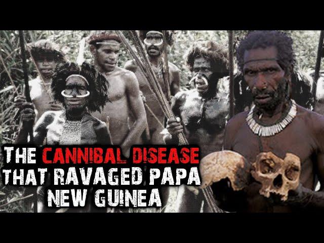 Kuru | The Cannibal Disease in Papua New Guinea