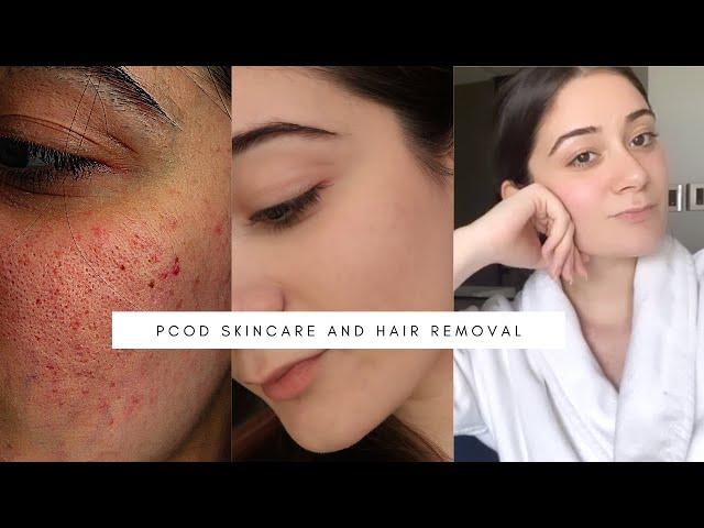 My PCOD Skincare | How I Got Rid of Acne & Facial Hair