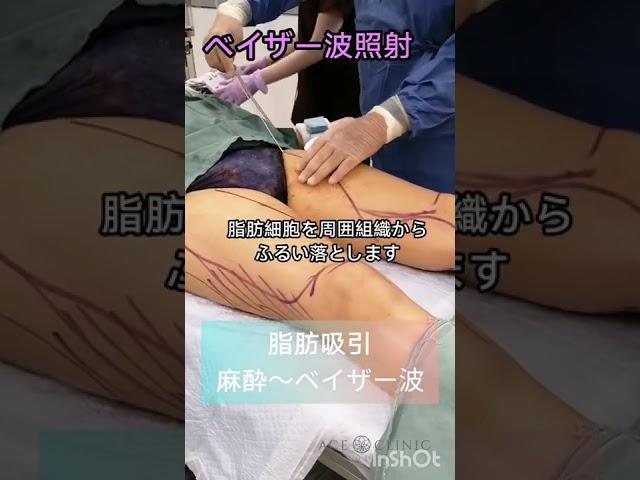 脂肪吸引　太もも全周+膝上　ベイザー波をかけて脂肪を取りやすく！【医師監修】 #Shorts