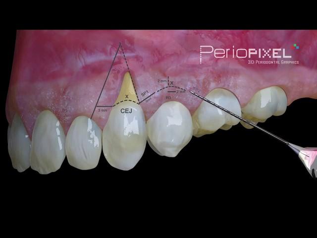 3D dental video - Laterally Moved and Coronally Advanced Flap - PerioPixel