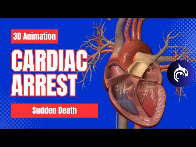 Cardiac Arrest (Sudden Death) - 3D Animation