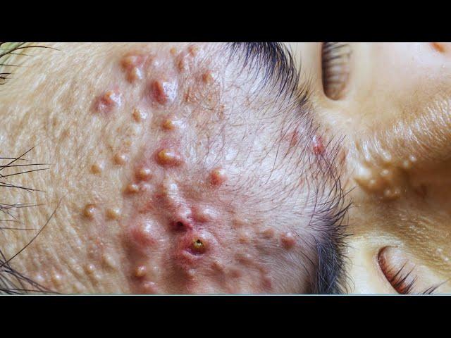  pimple squeezing  Extreme blackhead removal! #12