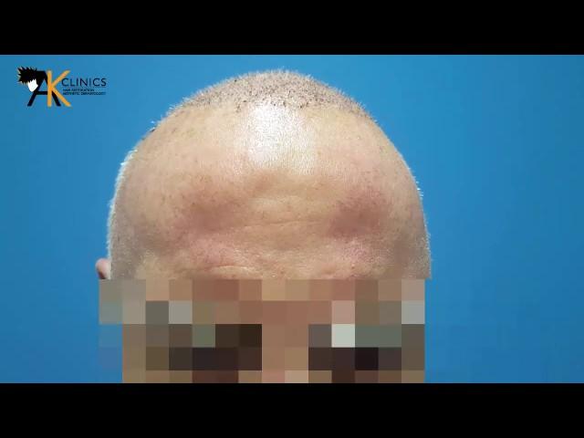 Body Hair Transplant - AK Clinics Review