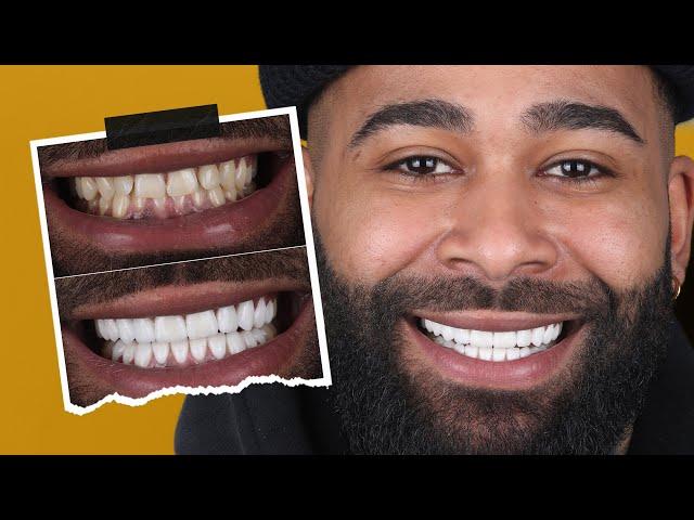 White and Natural-Looking Smile Designs | Maltepe Dental Clinic, Istanbul
