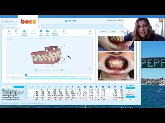 Treatment planning tips for Invisalign Clincheck: coaching by Dr Vandana Katyal