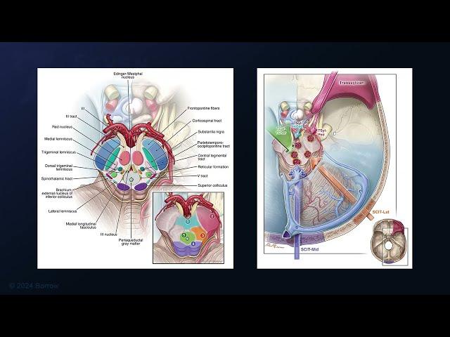 Resection of a Peduncular Tegmental Midbrain and Middle Peduncular Pontine Cavernous Malformation