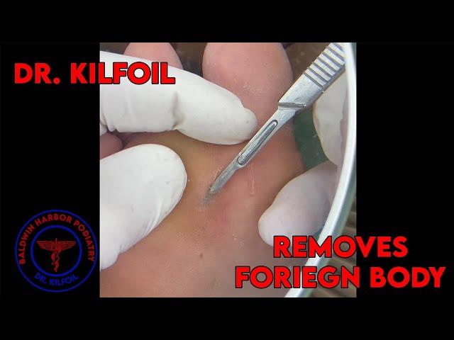 Dr. Kilfoil Removes A Foreign Body From Foot!