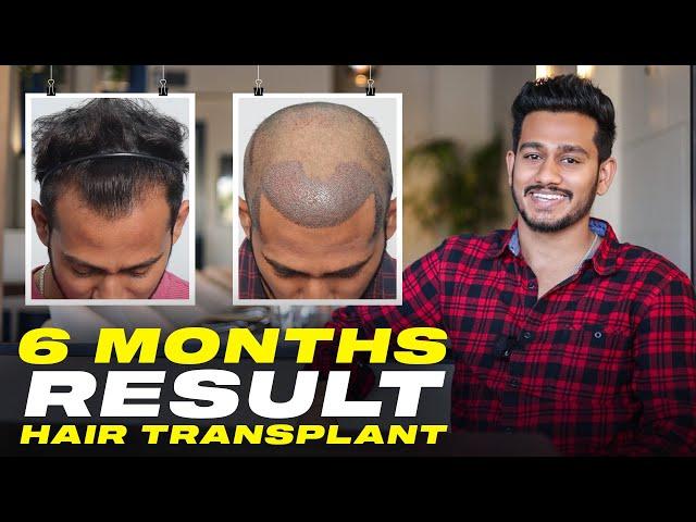 Hair Transplant in India | Best Results & Cost of Hair Transplant in India