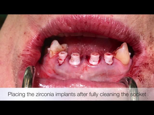 Immediate zirconia implants #3,4,7-10,13 - Keramik Sofortimplantate OK - Dr. Dominik Nischwitz