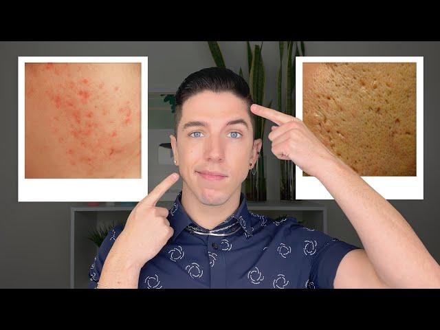 How to Get Rid of Acne Scars