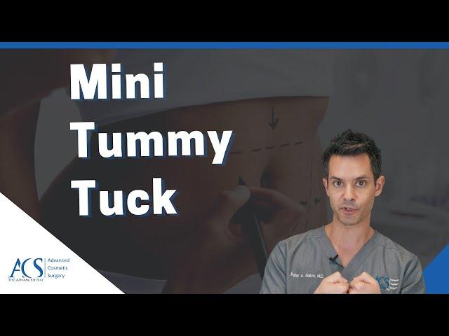 Mini Tummy Tuck Surgery Explained By Board Certified Plastic Surgeon